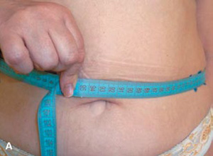 Окружность талии до процедуры кавитации тела 95 см