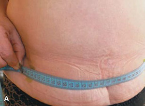 Cavitation-12-spina_300-220.jpg Cavitation-12-spina_300-220.jpg