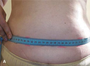 Cavitation-10-zhivot_300-220.jpg Cavitation-10-zhivot_300-220.jpg