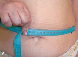 Cavitation-8-zhivot_300-220.jpg Cavitation-8-zhivot_300-220.jpg