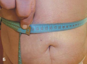 Cavitation-13-zhivot_300-220.jpg Cavitation-13-zhivot_300-220.jpg